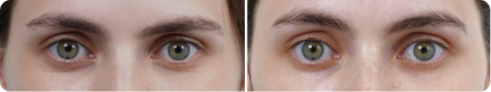 Before and after neck treatment
